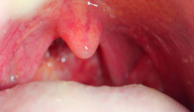 can tonsils grow back after being removed? - tymoff
