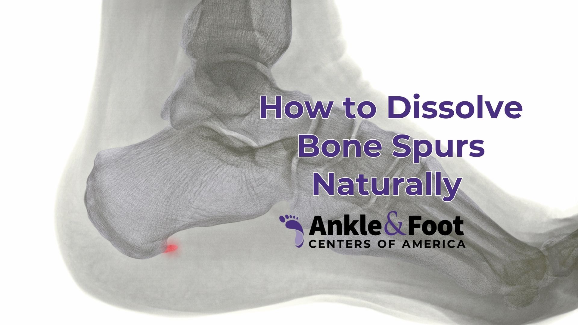 How To Dissolve Bone Spurs Naturally Quick Relief Tips Foto Blogs 1217