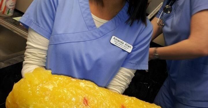 What Does 20 Pounds of Fat Look Like